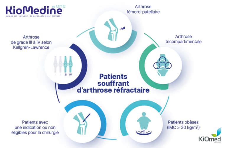 Article Qu Est Ce Que L Arthrose R Fractaire Arsylab